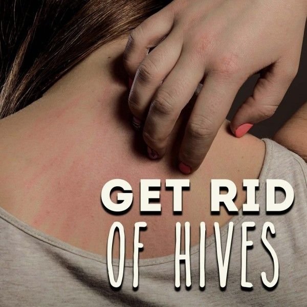 Relieve Hives Hypnosis